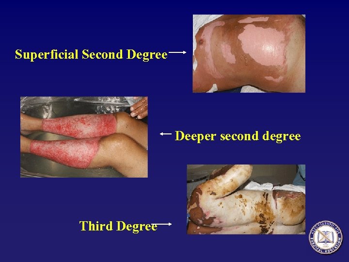 Superficial Second Degree Deeper second degree Third Degree 