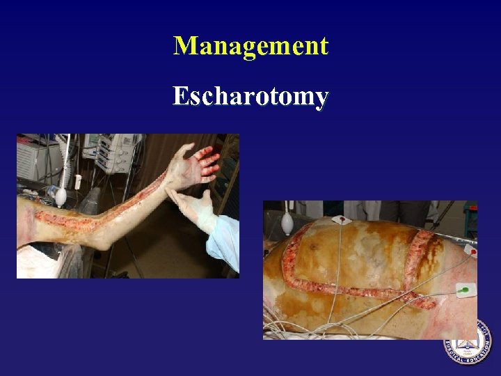 Management Escharotomy 