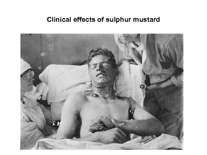 Clinical effects of sulphur mustard 