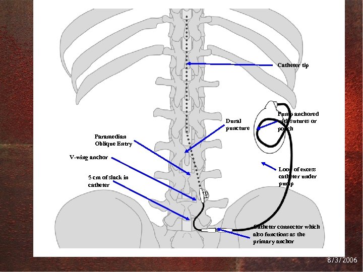 Catheter tip Dural puncture Pump anchored with sutures or pouch Paramedian Oblique Entry V-wing