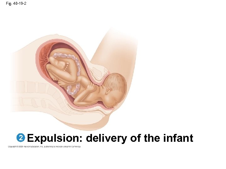 Fig. 46 -19 -2 2 Expulsion: delivery of the infant 