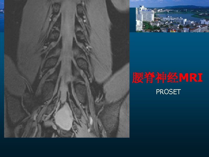 腰脊神经MRI PROSET 