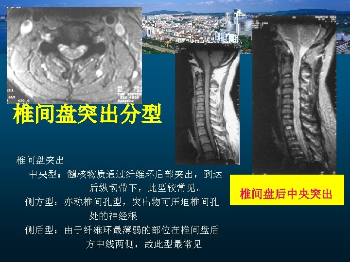 椎间盘突出分型 椎间盘突出 中央型：髓核物质通过纤维环后部突出，到达 后纵韧带下，此型较常见。 侧方型：亦称椎间孔型，突出物可压迫椎间孔 处的神经根 侧后型：由于纤维环最薄弱的部位在椎间盘后 方中线两侧，故此型最常见 椎间盘后中央突出 