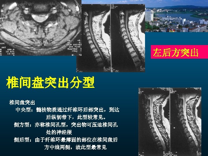 左后方突出 椎间盘突出分型 椎间盘突出 中央型：髓核物质通过纤维环后部突出，到达 后纵韧带下，此型较常见。 侧方型：亦称椎间孔型，突出物可压迫椎间孔 处的神经根 侧后型：由于纤维环最薄弱的部位在椎间盘后 方中线两侧，故此型最常见 