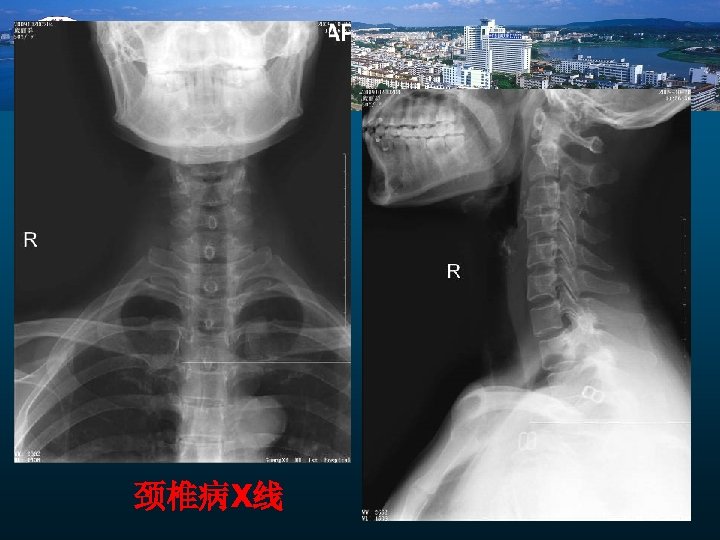 颈椎病X线 