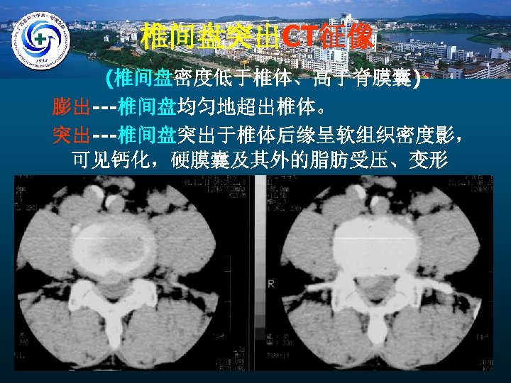 椎间盘突出CT征像 (椎间盘密度低于椎体、高于脊膜囊) 膨出---椎间盘均匀地超出椎体。 突出---椎间盘突出于椎体后缘呈软组织密度影， 可见钙化，硬膜囊及其外的脂肪受压、变形 