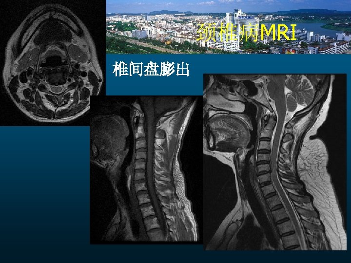 颈椎病MRI 椎间盘膨出 