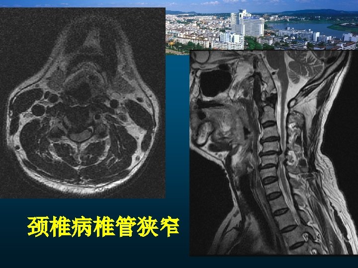 颈椎病椎管狭窄 