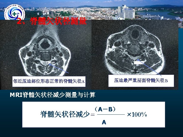 2、脊髓矢状径测量 压迫最严重层面脊髓矢径B 邻近压迫部位形态正常的脊髓矢径A MRI脊髓矢状径减少测量与计算 （A－B） 脊髓矢状径减少= A × 100% 