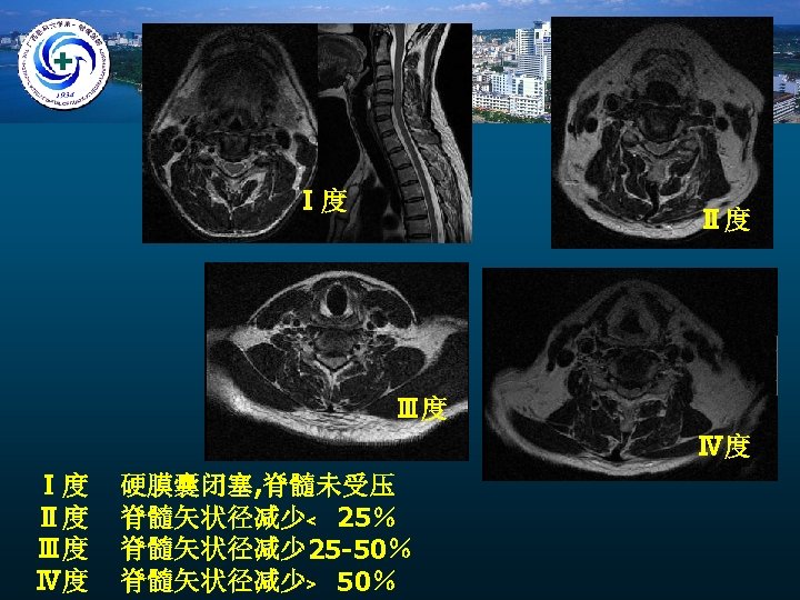 Ⅰ度 Ⅱ度 Ⅲ度 Ⅳ度 硬膜囊闭塞, 脊髓未受压 脊髓矢状径减少﹤ 25％ 脊髓矢状径减少 25 -50％ 脊髓矢状径减少﹥ 50％ 