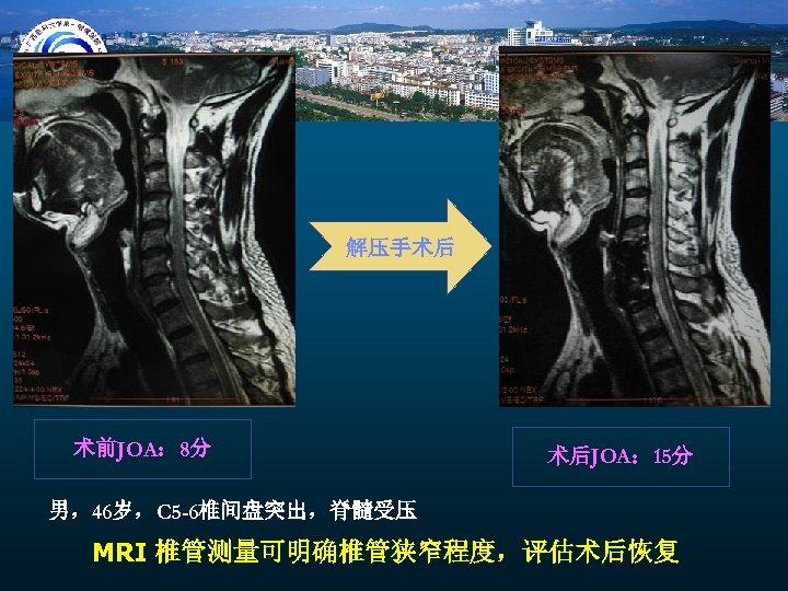 解压手术后 术前JOA： 8分 术后JOA： 15分 男，46岁，C 5 -6椎间盘突出，脊髓受压 MRI 椎管测量可明确椎管狭窄程度，评估术后恢复 