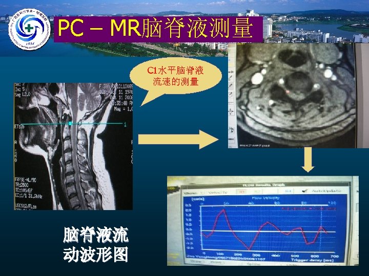 PC – MR脑脊液测量 C 1水平脑脊液 流速的测量 脑脊液流 动波形图 