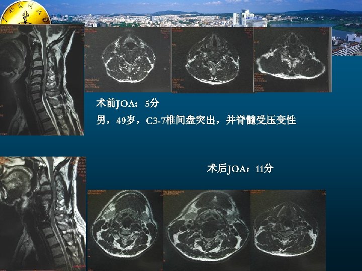 术前JOA： 5分 男，49岁，C 3 -7椎间盘突出，并脊髓受压变性 术后JOA： 11分 