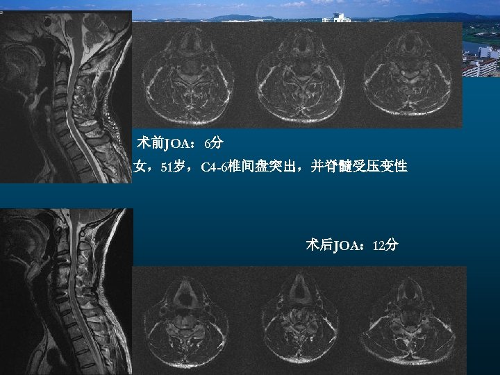术前JOA： 6分 女，51岁，C 4 -6椎间盘突出，并脊髓受压变性 术后JOA： 12分 