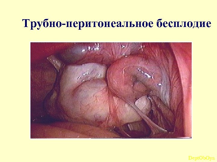 Трубно-перитонеальное бесплодие Dept. Ob. Gyn 