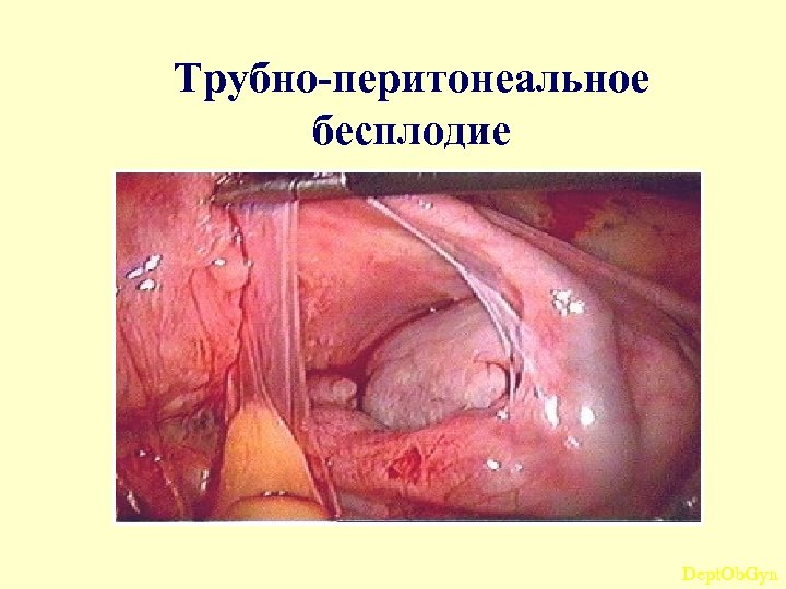 Трубно-перитонеальное бесплодие Dept. Ob. Gyn 