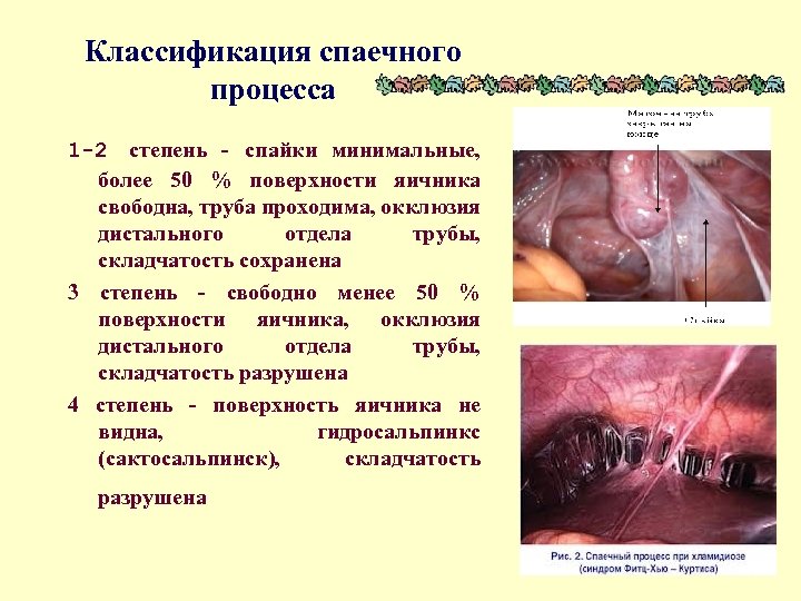 Классификация спаечного процесса 1 2 степень - спайки минимальные, более 50 % поверхности яичника