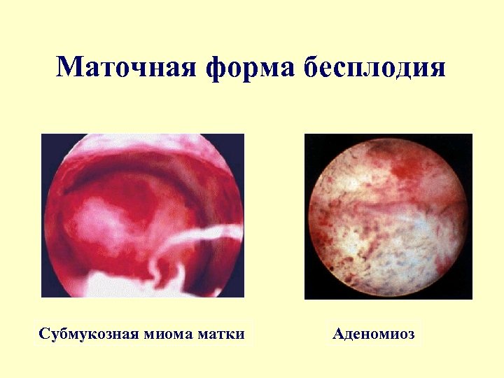 Маточная форма бесплодия Субмукозная миома матки Аденомиоз 