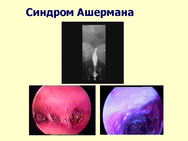 Синдром Ашермана 