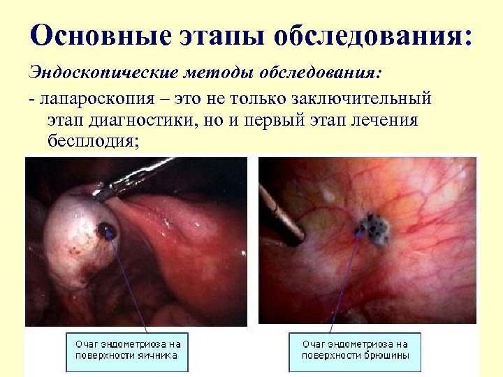 Основные этапы обследования: Эндоскопические методы обследования: - лапароскопия – это не только заключительный этап