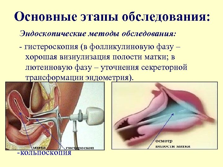Основные этапы обследования: Эндоскопические методы обследования: - гистероскопия (в фолликулиновую фазу – хорошая визиулизация
