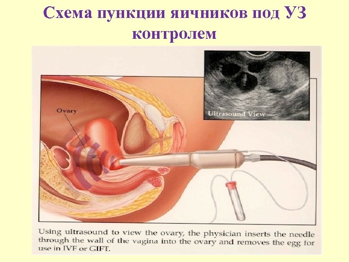 Схема пункции яичников под УЗ контролем 
