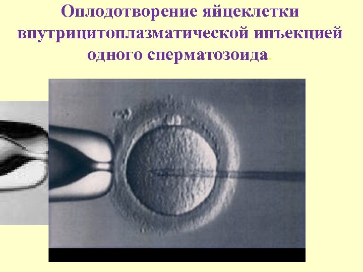Оплодотворение яйцеклетки внутрицитоплазматической инъекцией одного сперматозоида. 