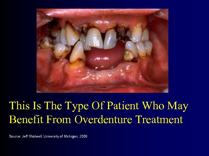 This Is The Type Of Patient Who May Benefit From Overdenture Treatment Source: Jeff