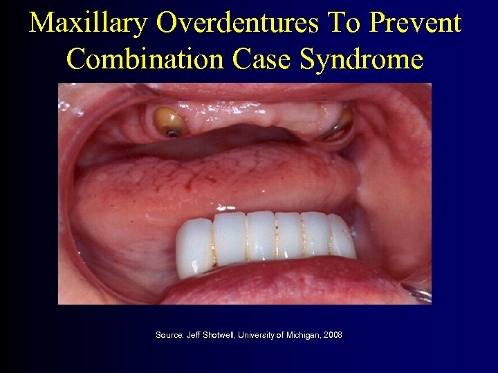 Maxillary Overdentures To Prevent Combination Case Syndrome Source: Jeff Shotwell, University of Michigan, 2008