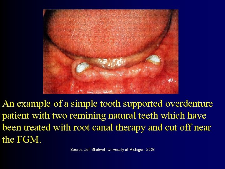 An example of a simple tooth supported overdenture patient with two remining natural teeth