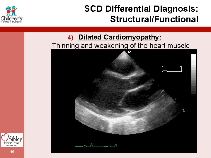 SCD Differential Diagnosis: Structural/Functional 4) Dilated Cardiomyopathy: Thinning and weakening of the heart muscle