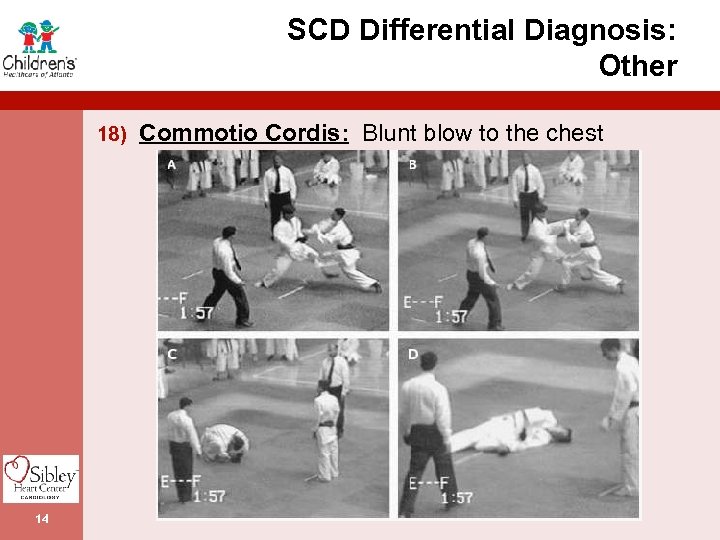 SCD Differential Diagnosis: Other 18) Commotio Cordis: Blunt blow to the chest 14 