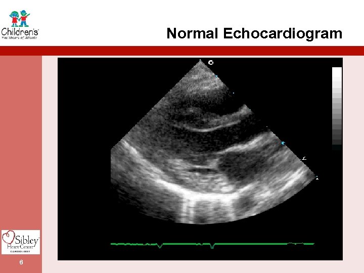 Normal Echocardiogram 6 