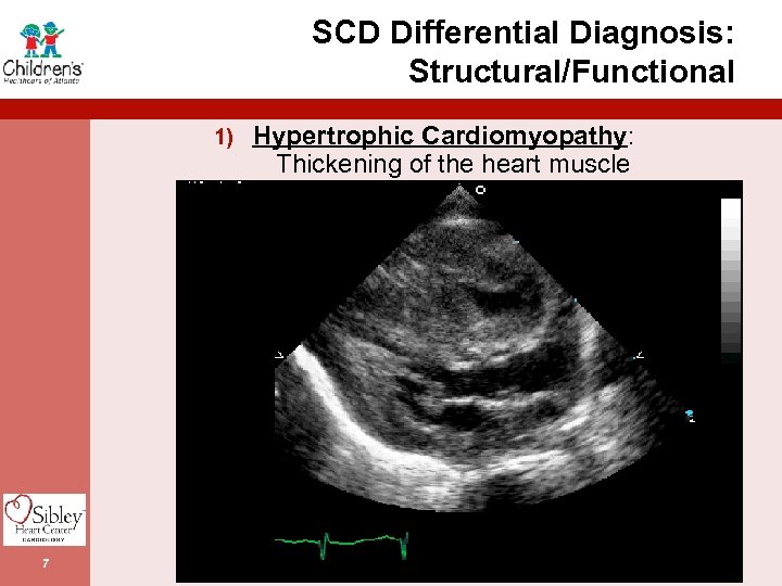 SCD Differential Diagnosis: Structural/Functional 1) Hypertrophic Cardiomyopathy: Thickening of the heart muscle 7 