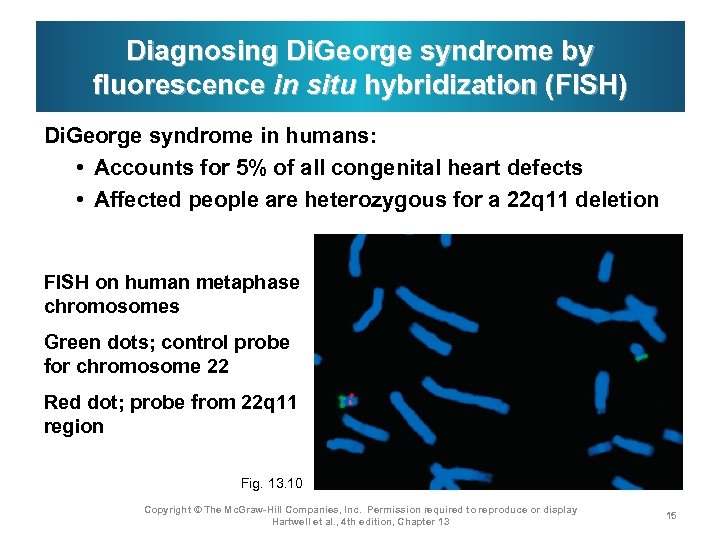 Diagnosing Di. George syndrome by fluorescence in situ hybridization (FISH) Di. George syndrome in