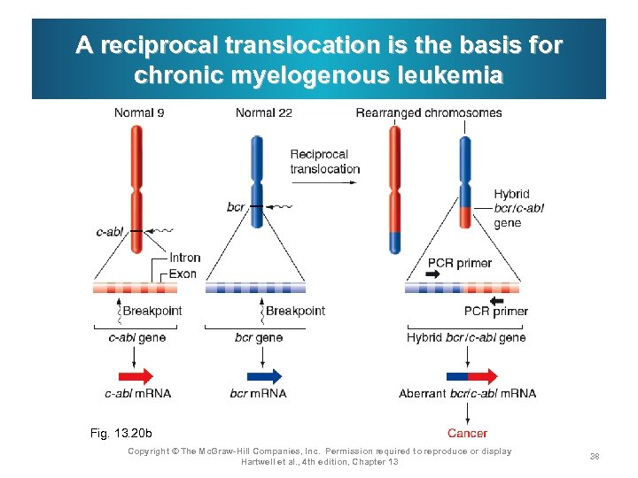 A reciprocal translocation is the basis for chronic myelogenous leukemia Fig. 13. 20 b