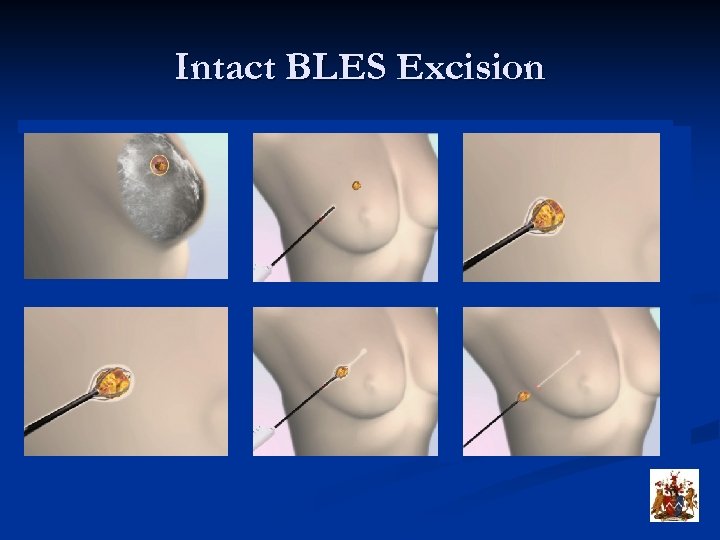 Intact BLES Excision 