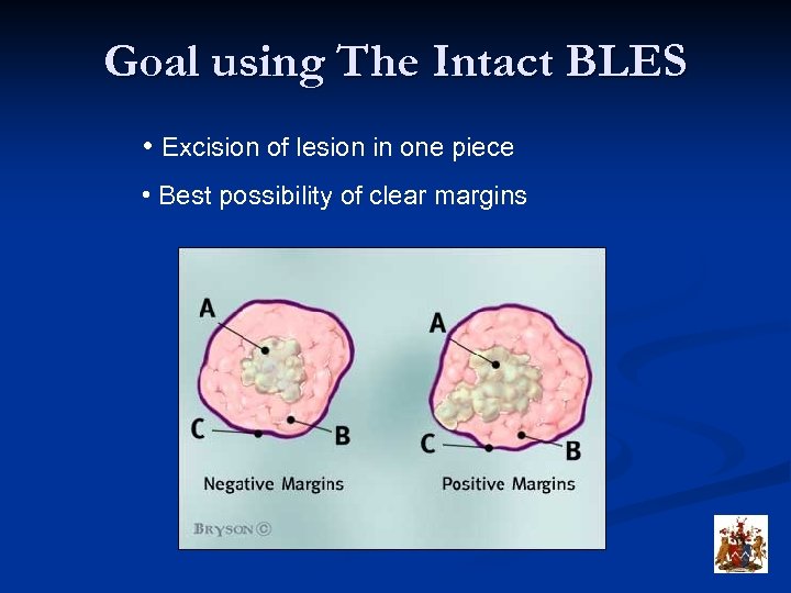 Goal using The Intact BLES • Excision of lesion in one piece • Best