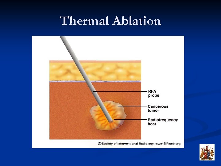 Thermal Ablation 