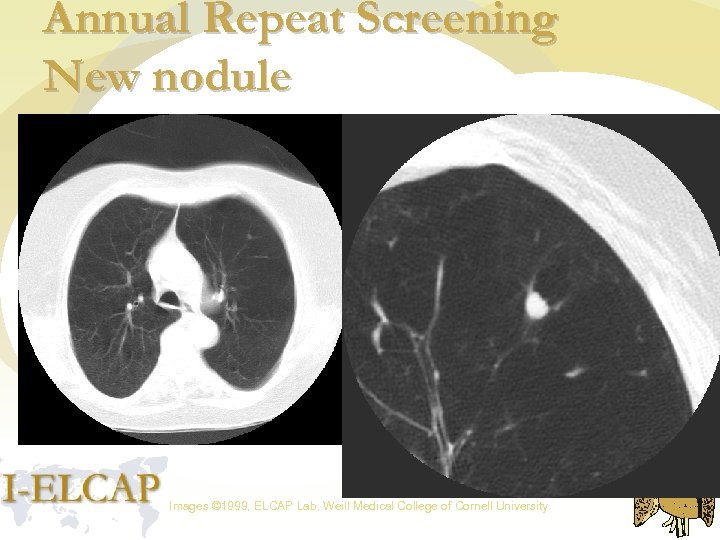 Annual Repeat Screening New nodule Images © 1999, ELCAP Lab, Weill Medical College of