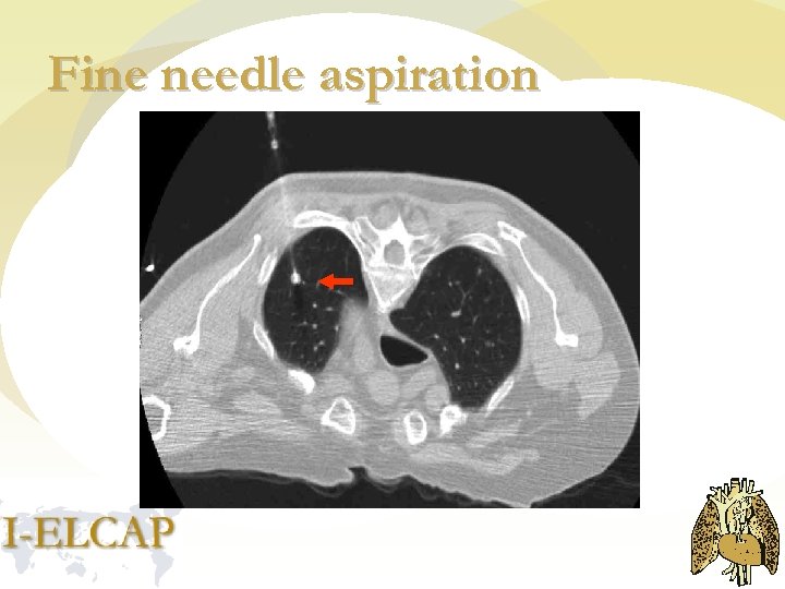 Fine needle aspiration 