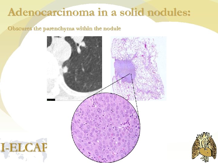 Adenocarcinoma in a solid nodules: Obscures the parenchyma within the nodule 