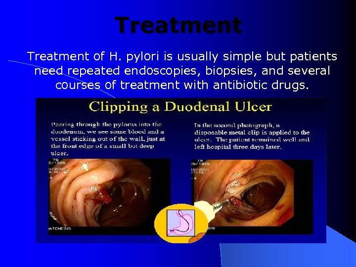 Treatment of H. pylori is usually simple but patients need repeated endoscopies, biopsies, and