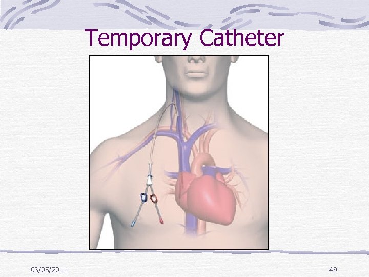 Temporary Catheter 03/05/2011 49 