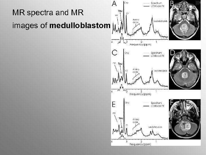 MR spectra and MR images of medulloblastoma 