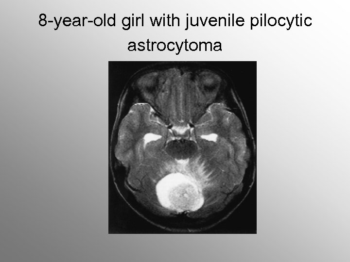 8 -year-old girl with juvenile pilocytic astrocytoma 