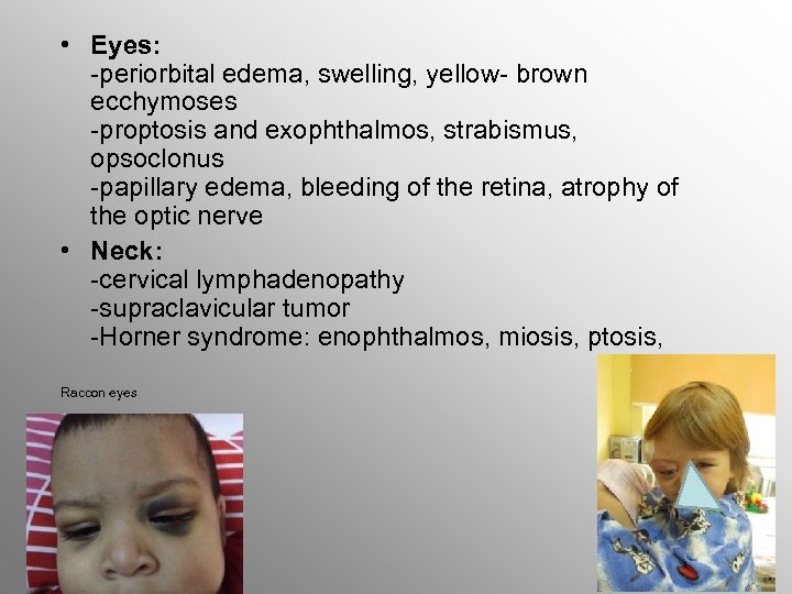  • Eyes: -periorbital edema, swelling, yellow- brown ecchymoses -proptosis and exophthalmos, strabismus, opsoclonus