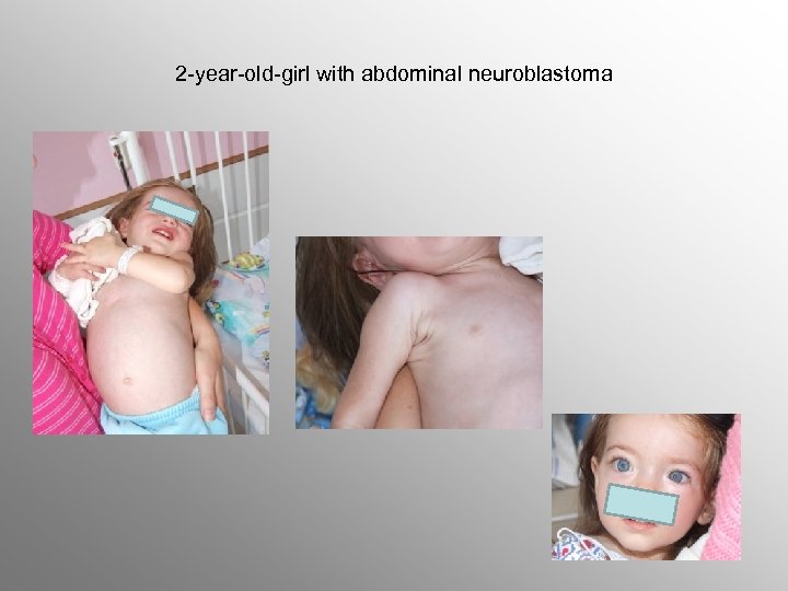 2 -year-old-girl with abdominal neuroblastoma 