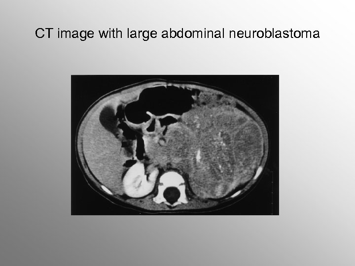 CT image with large abdominal neuroblastoma 