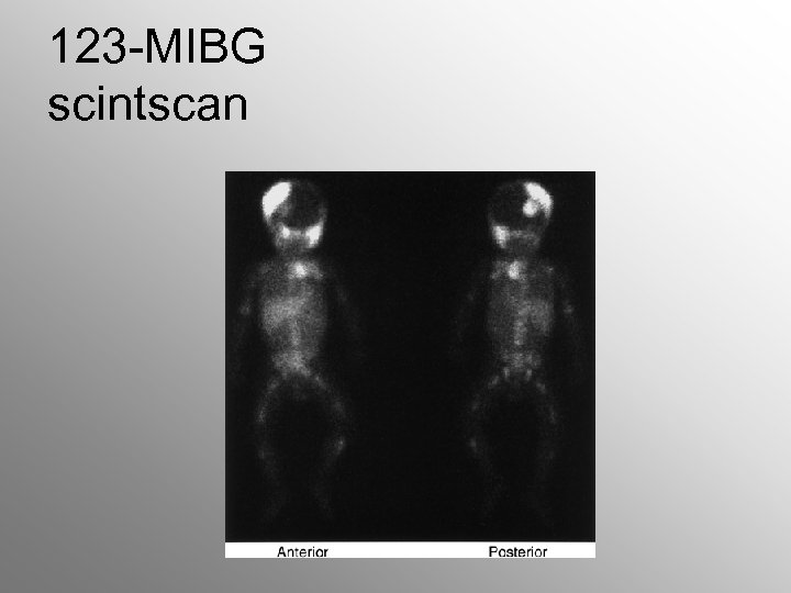 123 -MIBG scintscan 
